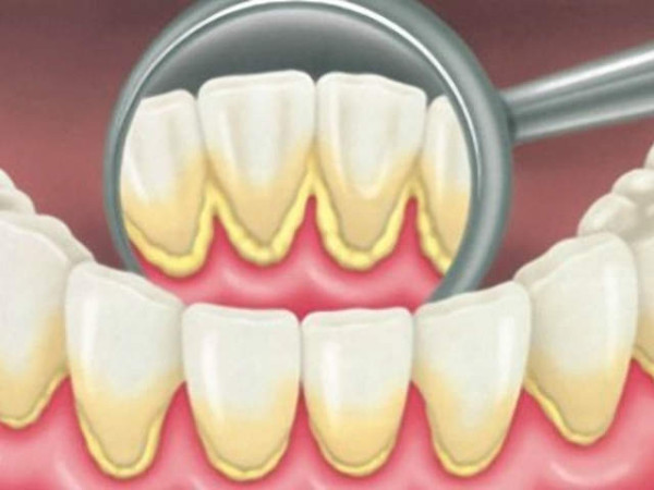Wat-is-tandplak-vraag-hulp-aan-tandartsen-van-de-Darwinkliniek-Zoetermeer (1)