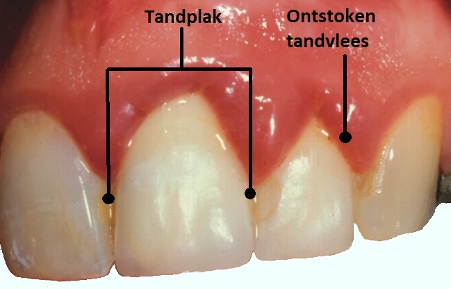 verwijderen-vantandplak-door-de-tandartsen-van-de-Darwinkliniek-Zoetermeer